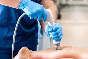 Spider Vein Laser Treatment