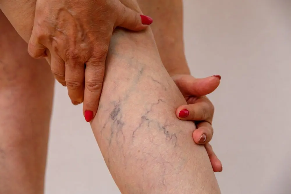 Spider Veins in Mumbai