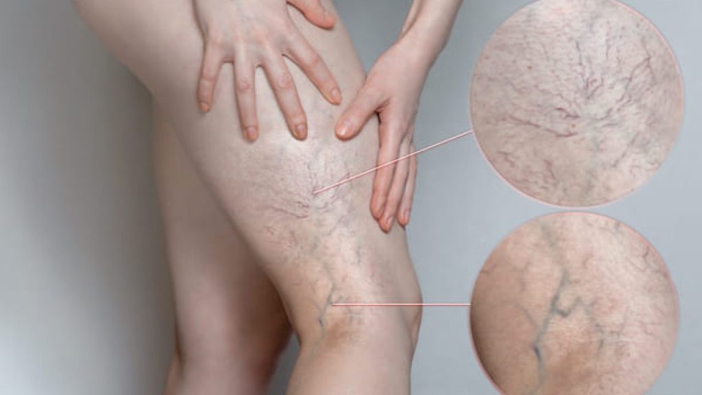 Varicose vein treatment in Dombivli