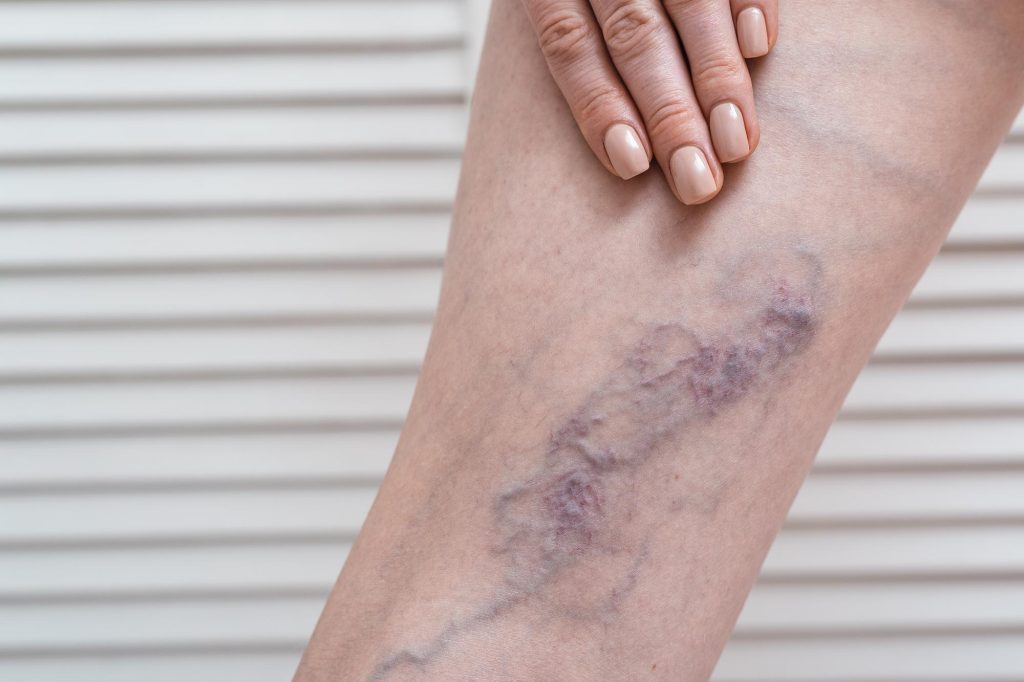 Spider veins treatment in Mumbai