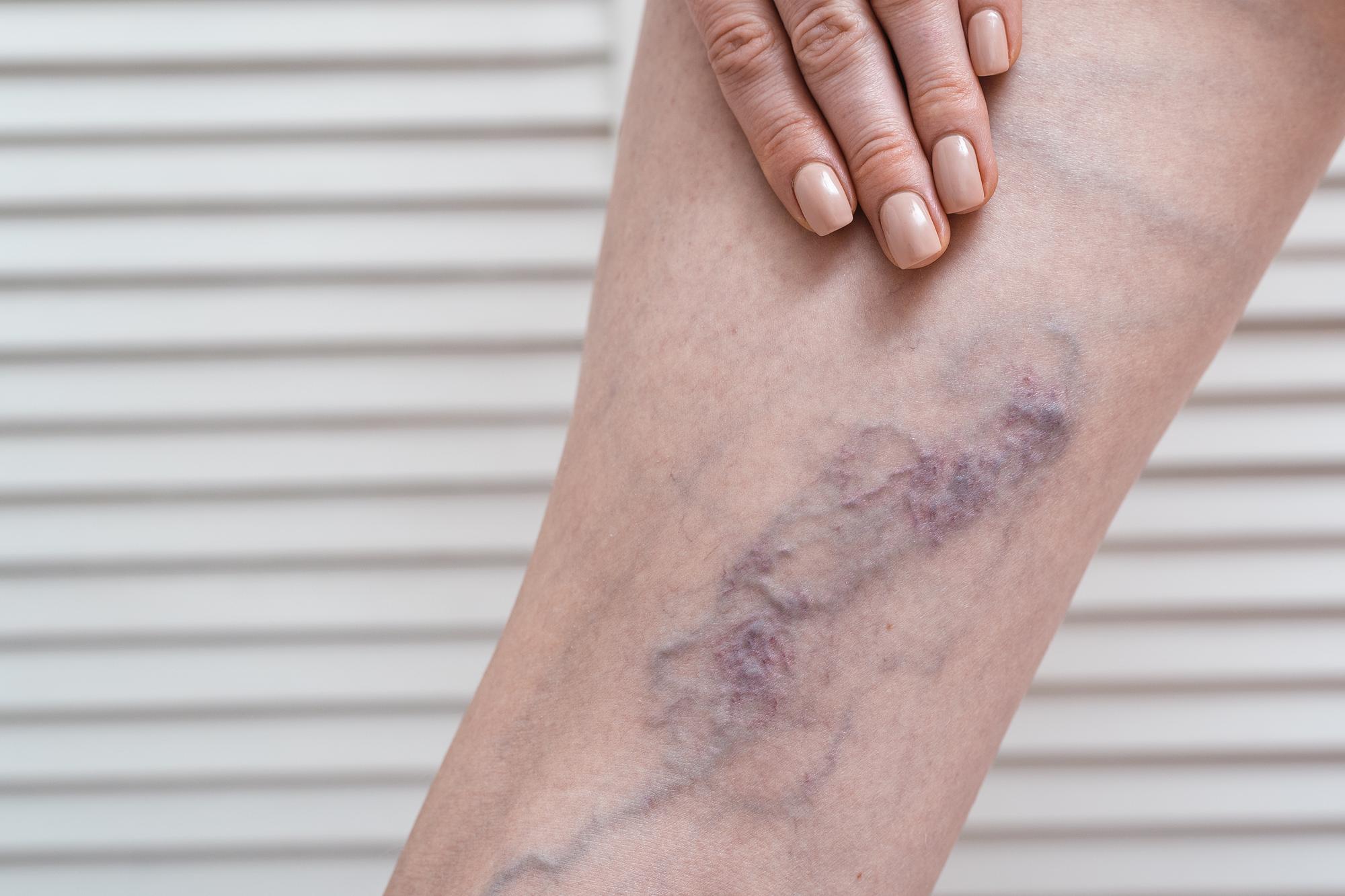 Spider veins treatment in Mumbai