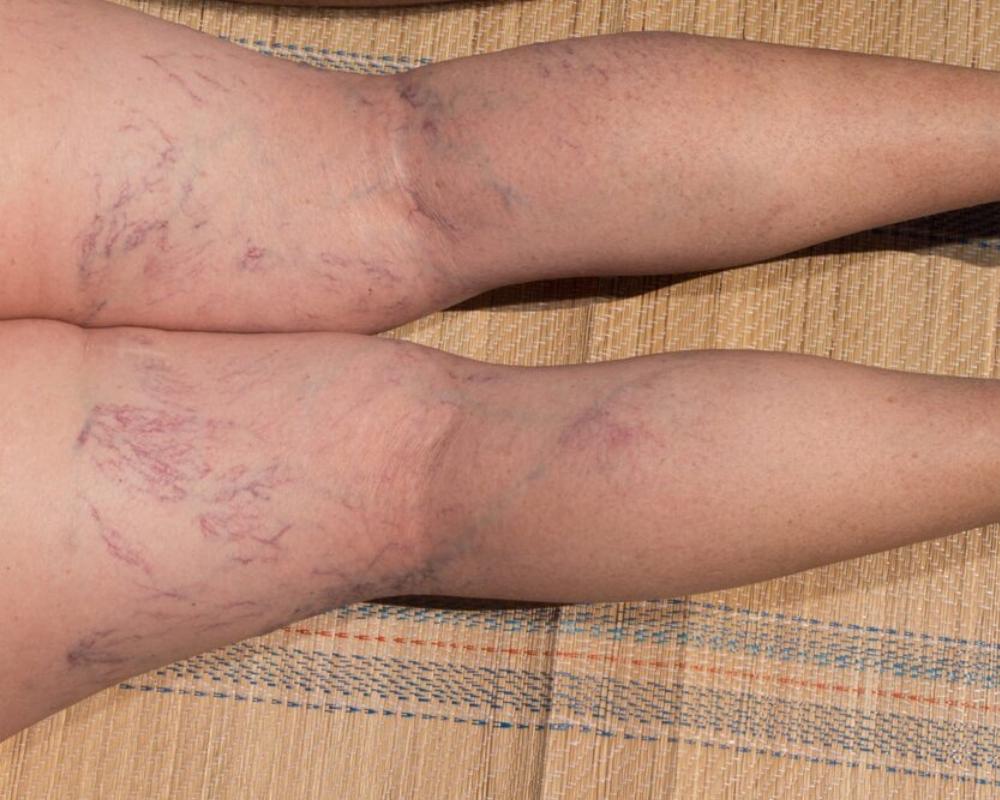 Spider veins treatment in Mumbai
