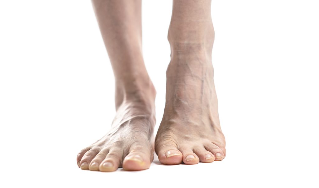 Best Shoes for Varicose Veins