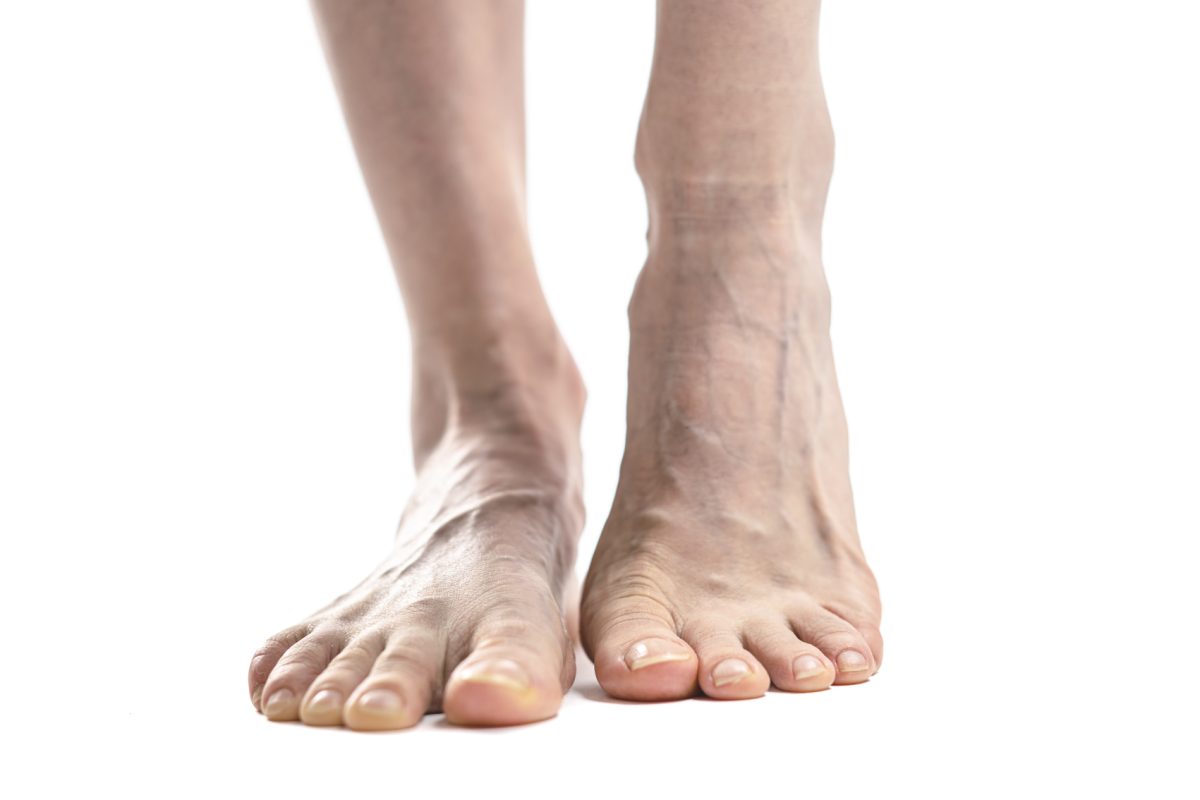 Best Shoes for Varicose Veins