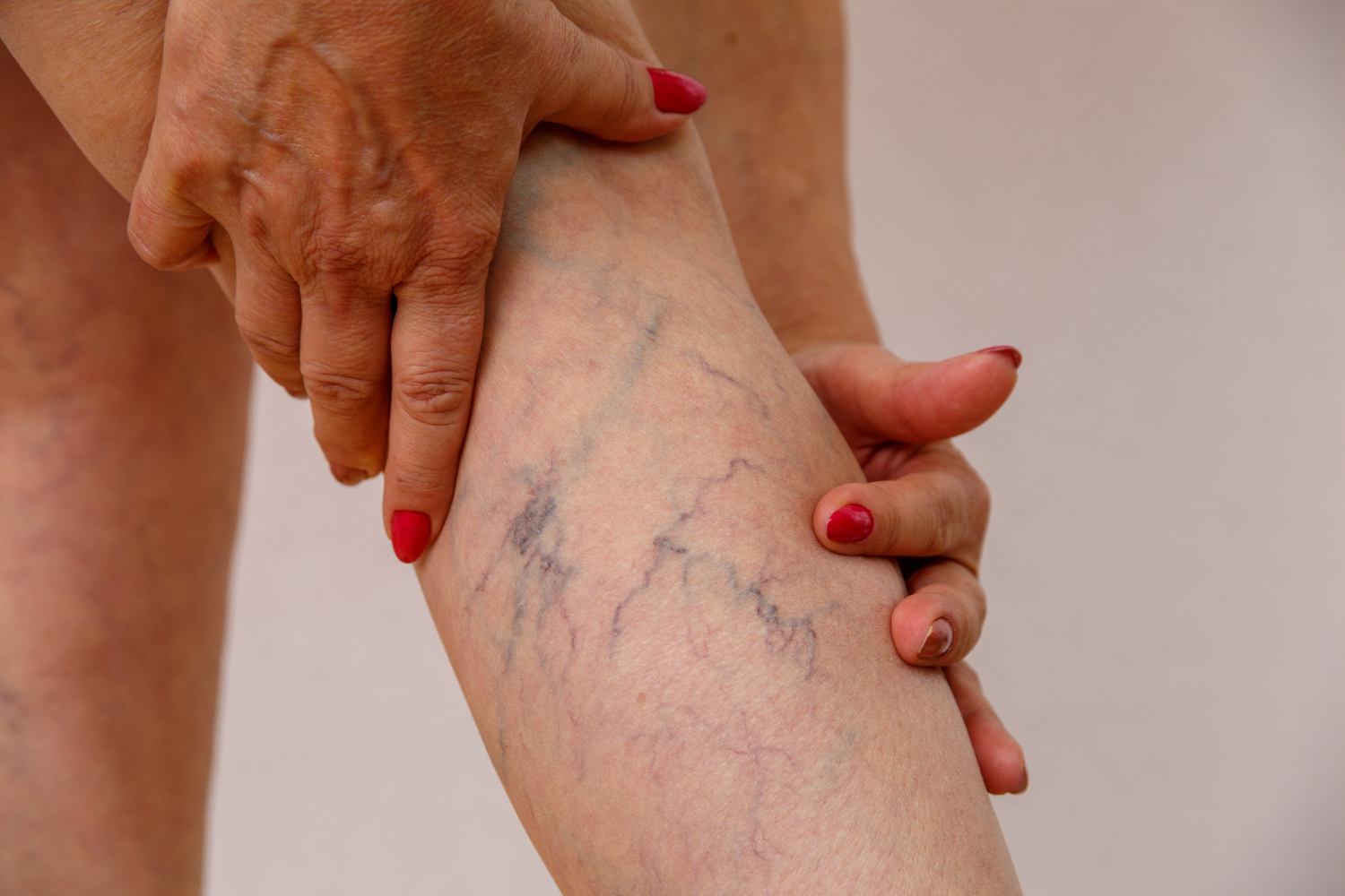 Laser Treatments for Spider Veins