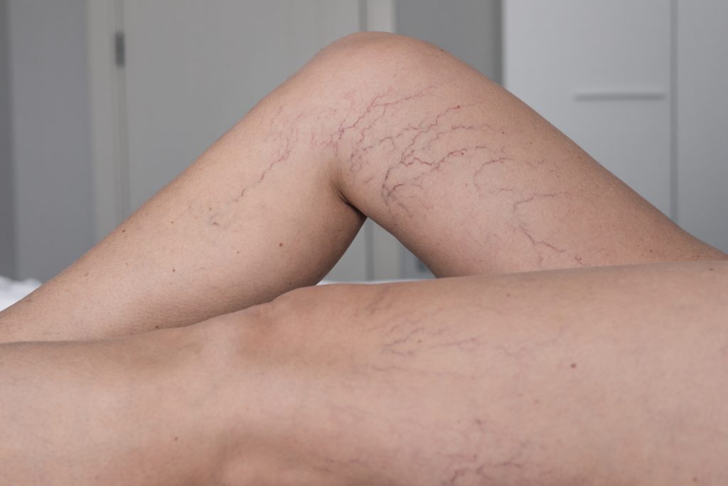 Invisible Veins treatment in Thane