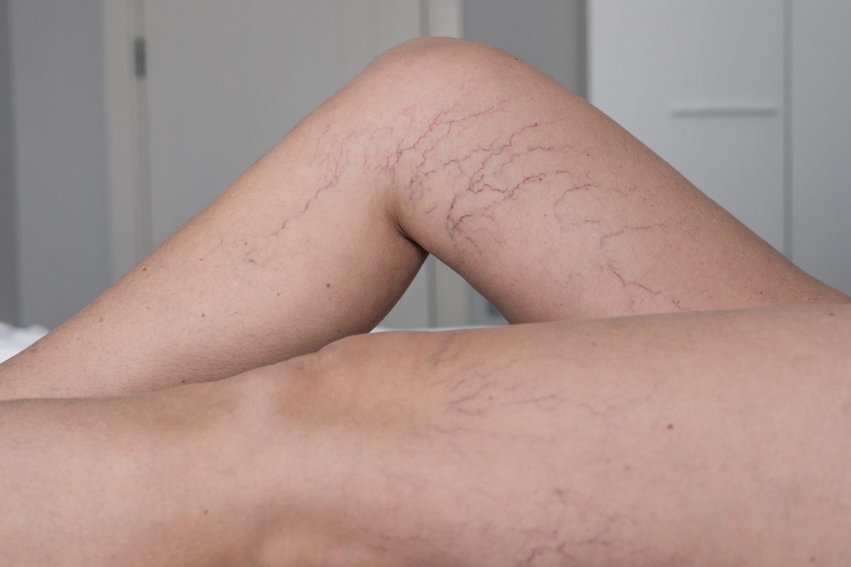 Invisible Veins treatment in Thane