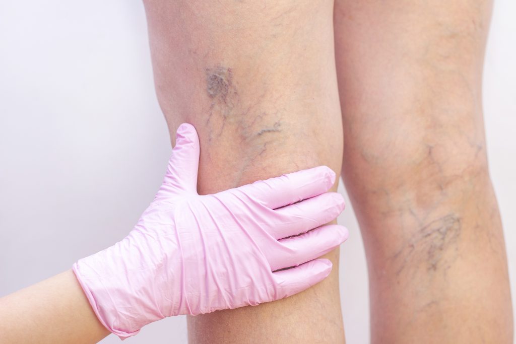 CLaCS Treatment in Palava