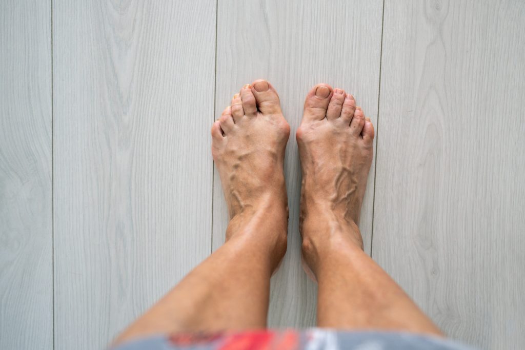 Varicose veins