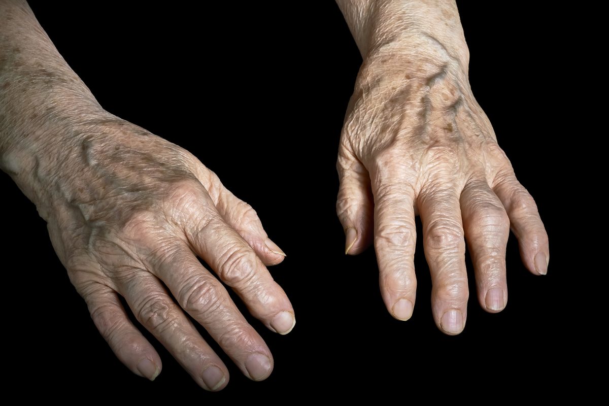 varicose veins treatment in Mumbai