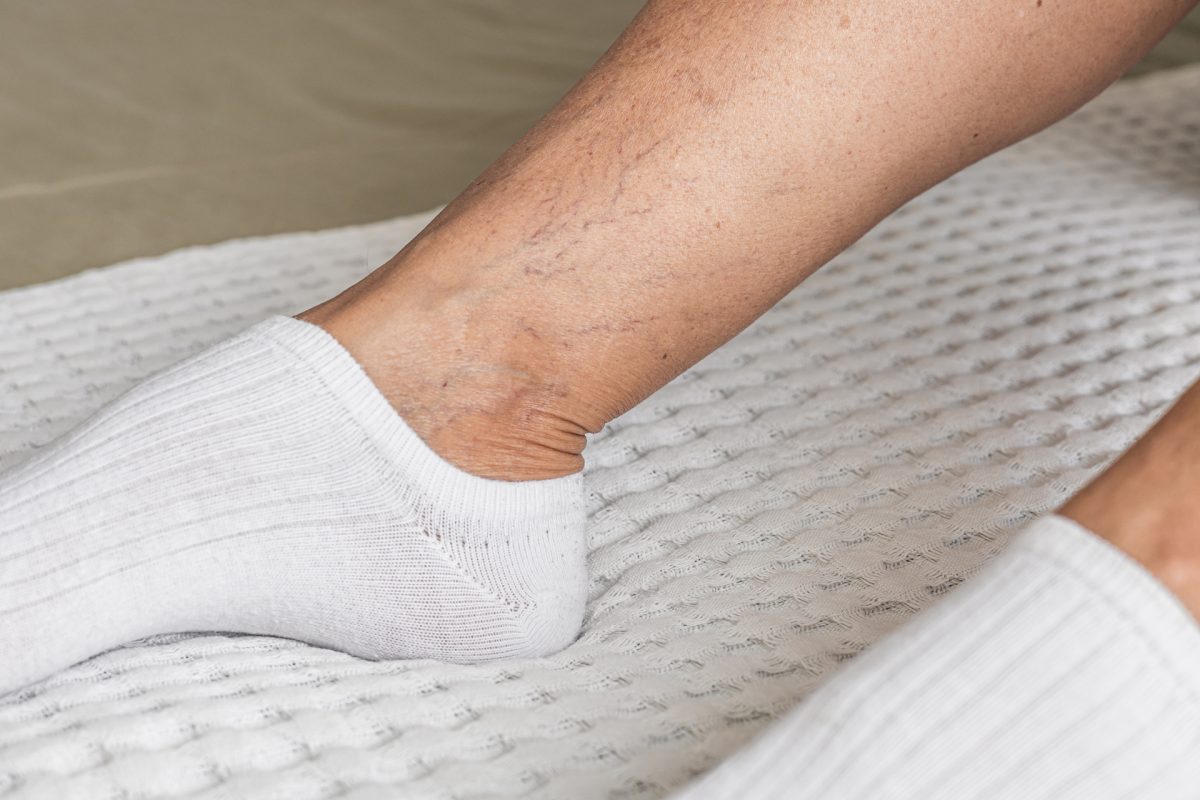 Tiny Veins on Legs