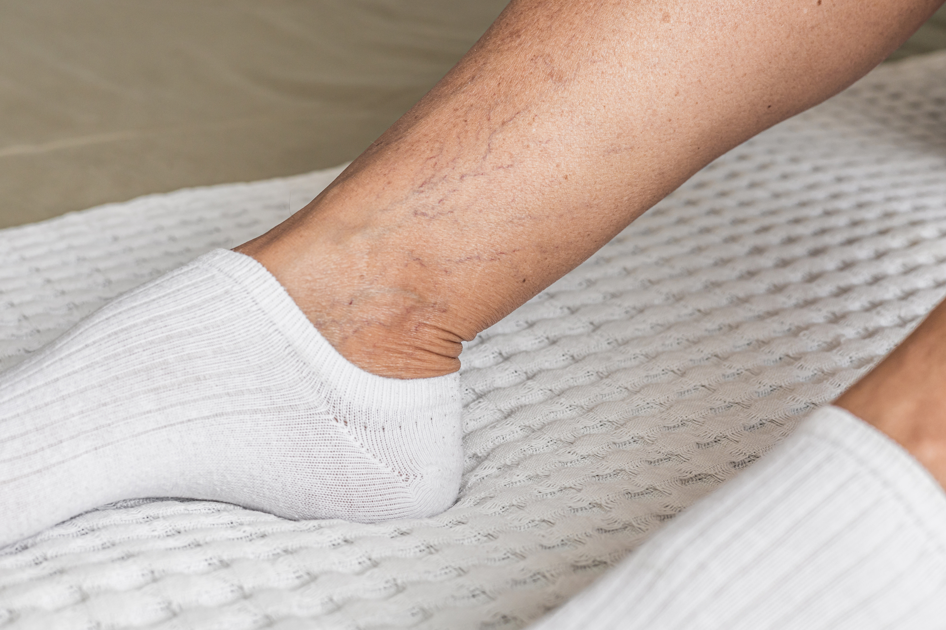 Tiny Veins on Legs