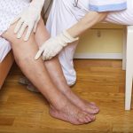 varicose veins